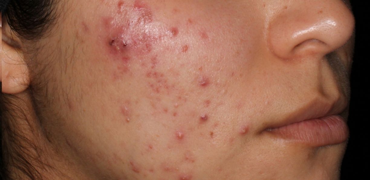 Before image for AviClear.