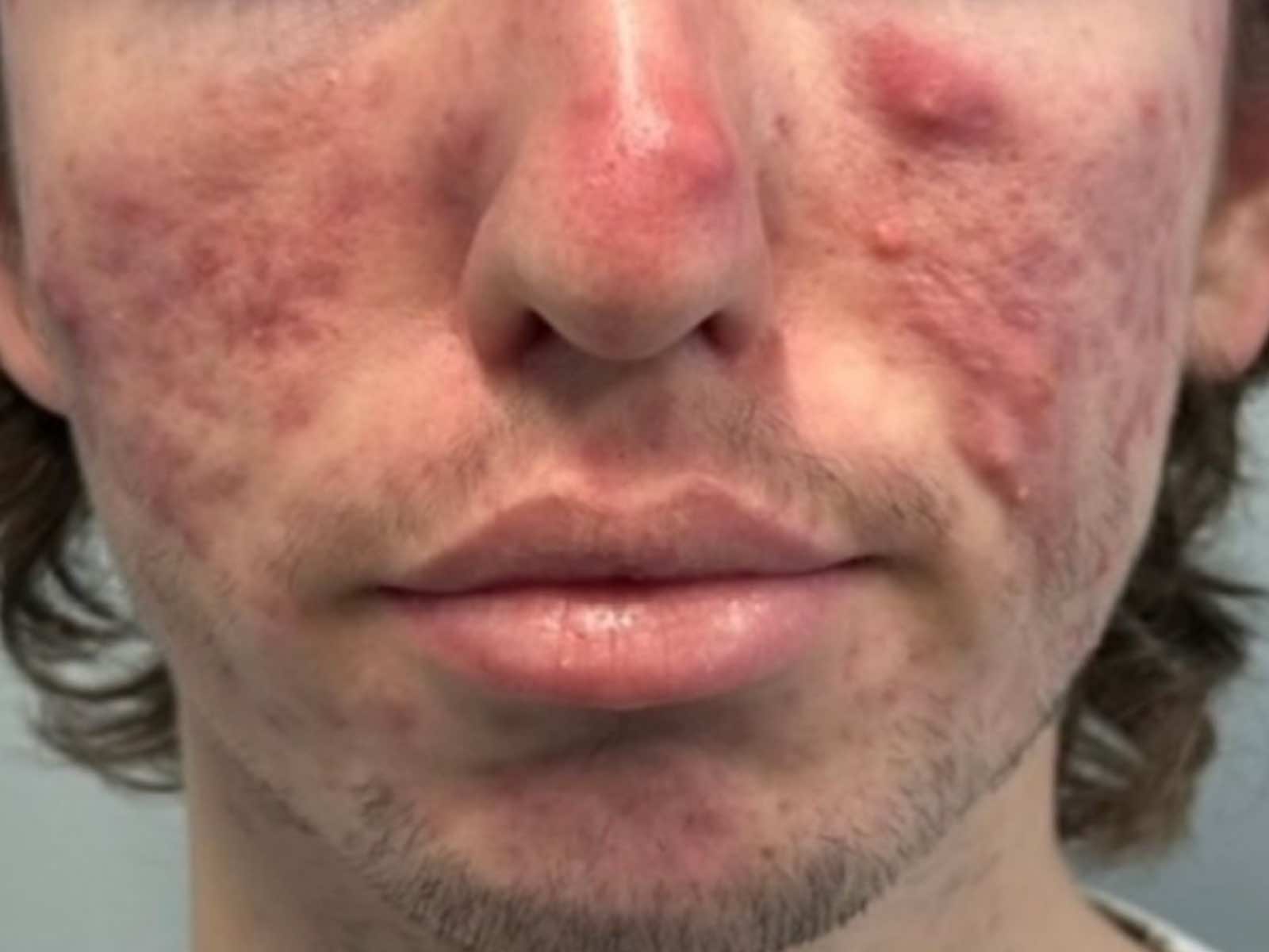 Before image for AviClear.