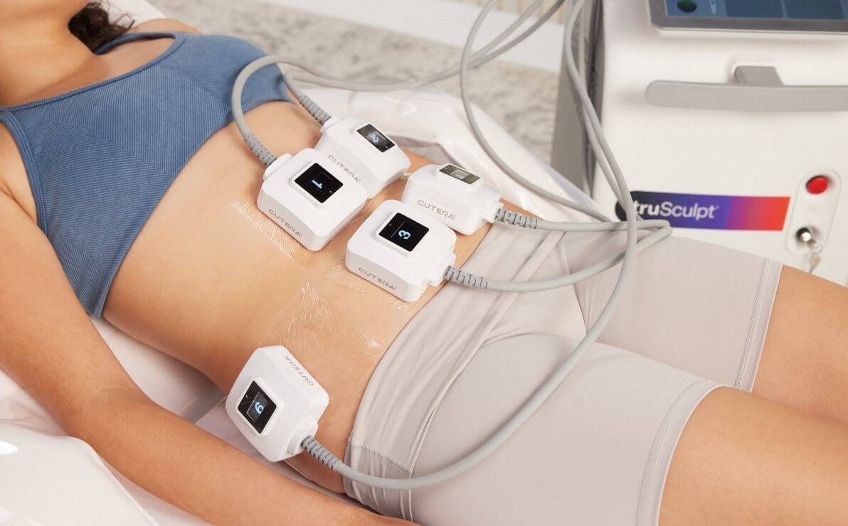 A closeup view of a truSculpt treatment being performed on the abs of a patient.
