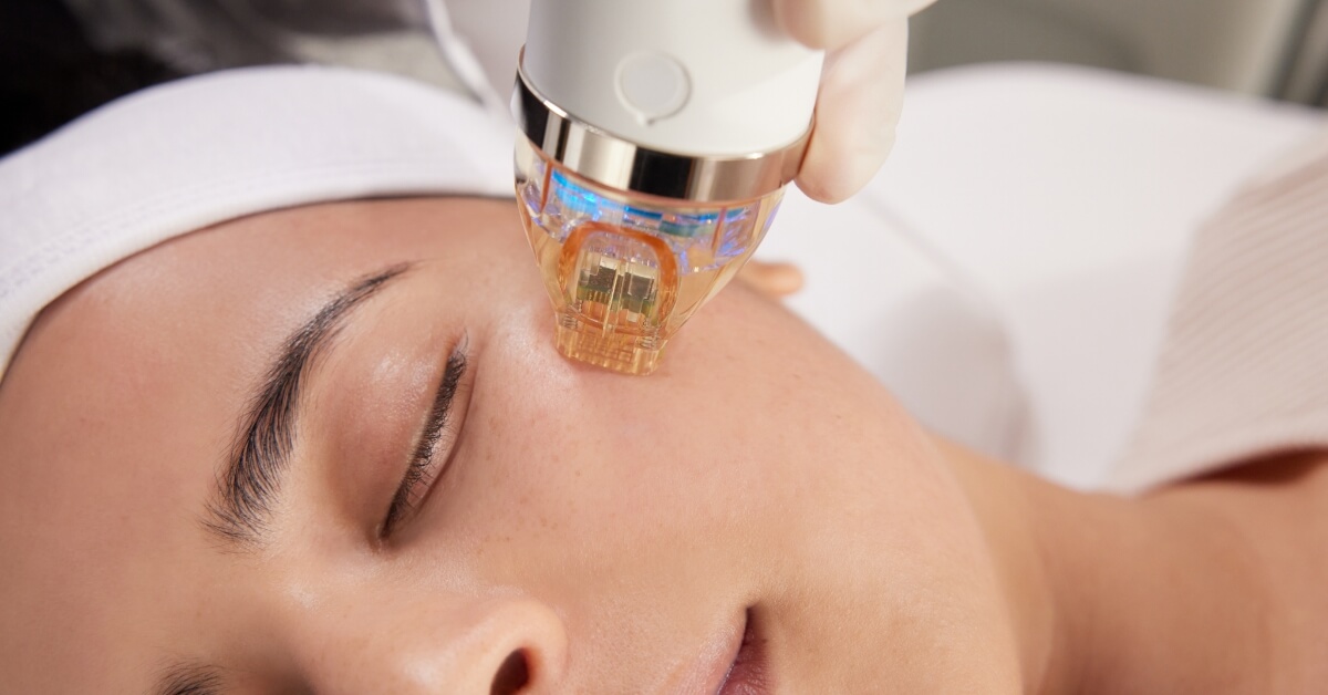 A face getting a micro-needling treatment done.